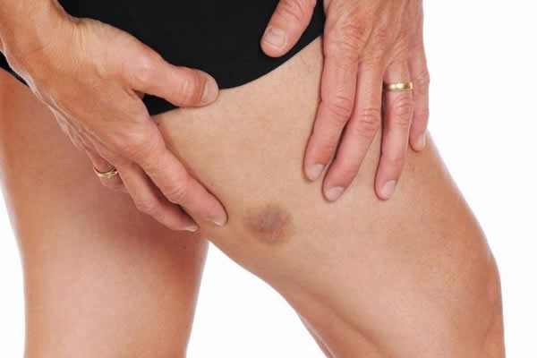Como evitar manchas na pele?