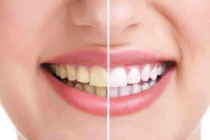 Quais as melhorias na saúde da sua boca, com o plano dental?